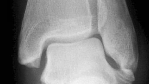 La radio d’une cheville